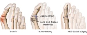 Illustration of a foot before, during and after bunion surgery